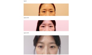 [후기] 쌍커플+눈매교정, 눈밑지방재배치